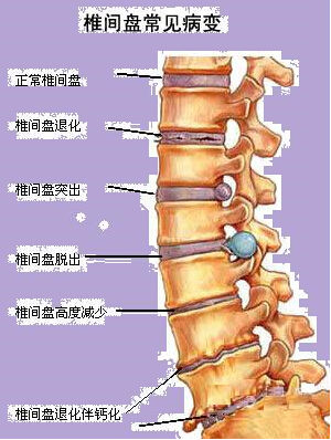 骨科专家魏美钢:90%腰椎间盘突出患者不需要手术