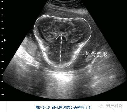 超声笔记no1102胎儿骨骼系统畸形超声诊断