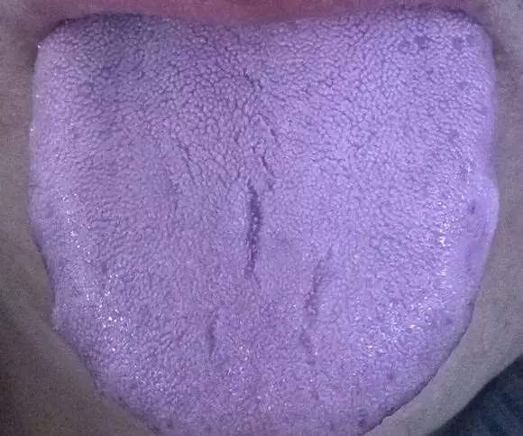 如果你舌头有发紫的现象,这个时候你就要注意了,舌头发紫一般是由于
