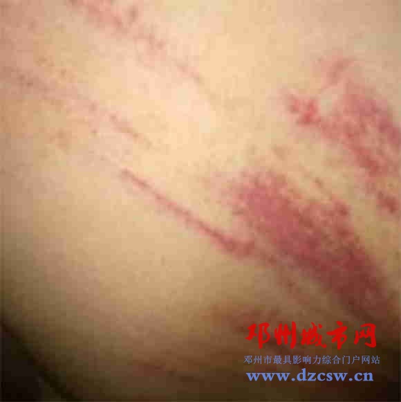 网曝邓州某小学老师用竹竿将学生后背打出血印