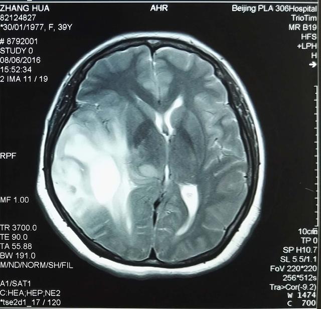 脑肿瘤ct图片解说图图片