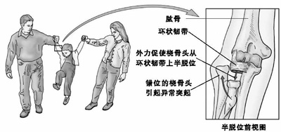 男孩胳膊脱臼连夜送医,爸爸千万别再做这个动作了