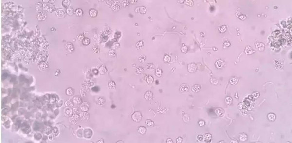 干化学指标变化不大,沉渣结果相差甚远:大量白细胞,少量真菌 细菌
