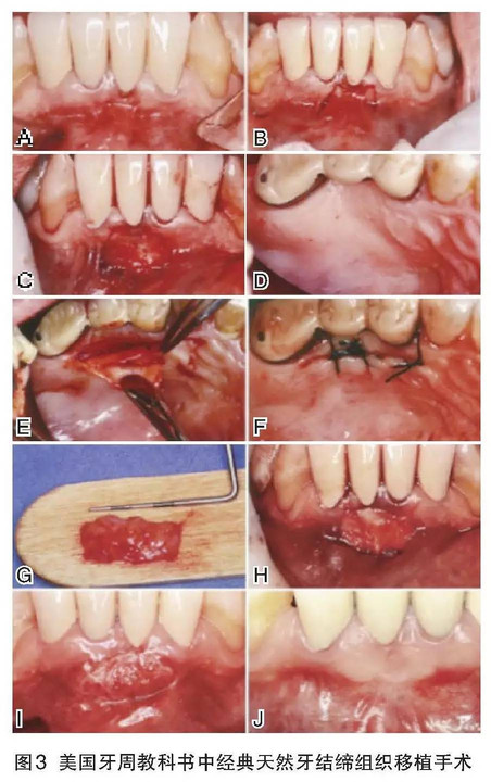 膜龈手术的临床问题讨论对于角化龈增宽的手术,种植界一直存在争议