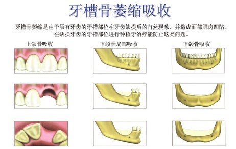 2,牙槽嵴吸收和萎缩当一颗牙缺失后,如长时间不修复,对牙会伸长,缺牙