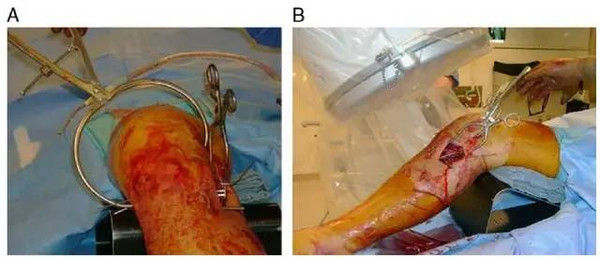 手术技巧:闲庭信步处理胫骨平台骨折伴脱位