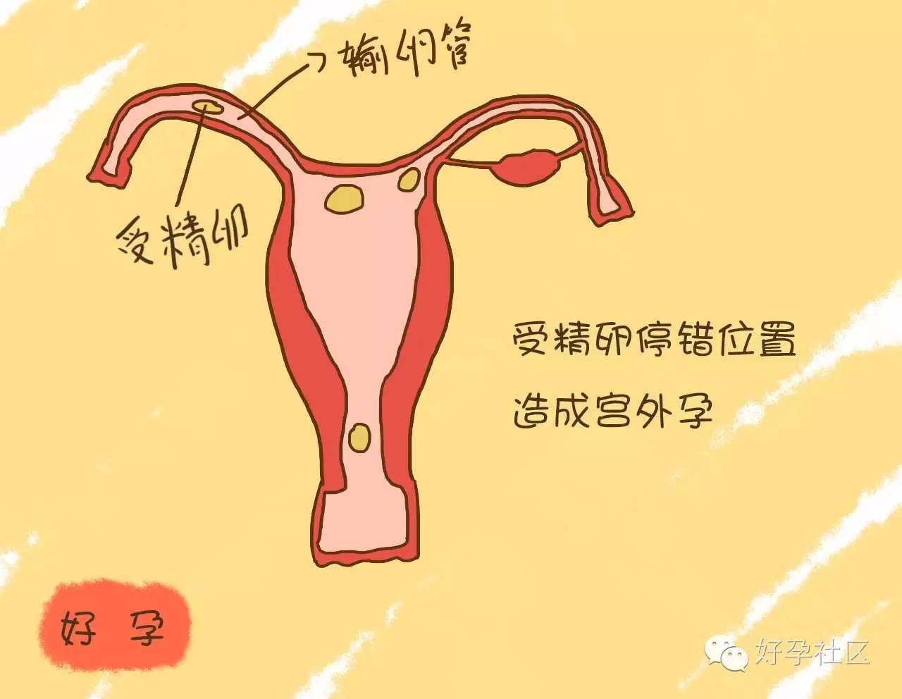 胚胎着床在小腹哪一侧图片