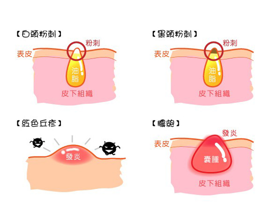 皮膚長痘痘的危害和護理辦法