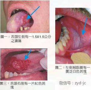 槟榔口腔癌图片晚期图片