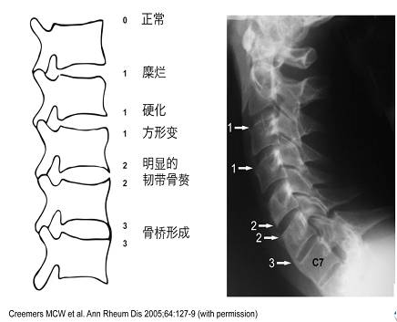 骨桥形成图片