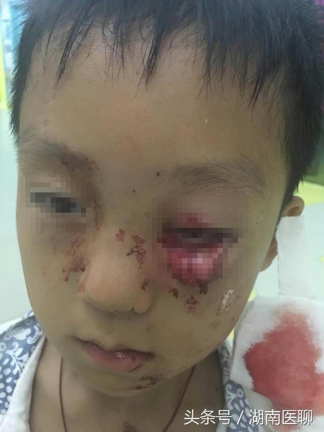 湖南9岁孩童左眼被狗抓伤伤眼不忍直视