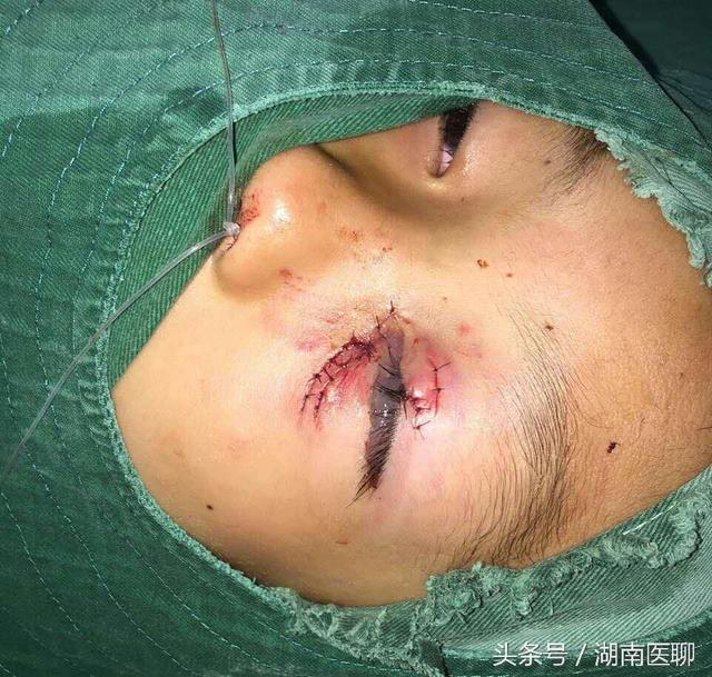湖南9岁孩童左眼被狗抓伤伤眼不忍直视