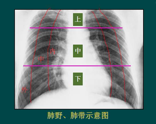 肺炎胸片图解解读图片