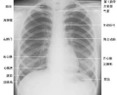 正常肺部片子图片图片