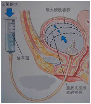 膀胱热灌注图片