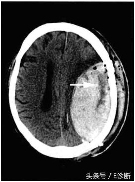 e診斷:腦部影像學-硬膜外血腫-搜狐