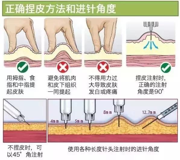 肌肉注射定位方法图片图片