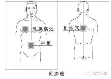 通常男性患上乳腺癌,一发现都已是中晚期,于大爷很幸运,目前还处于