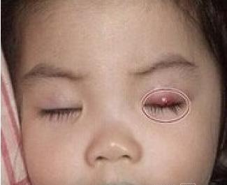儿童眼睛过敏症状图片图片
