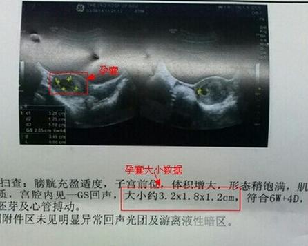 胎囊和孕囊的区别图片