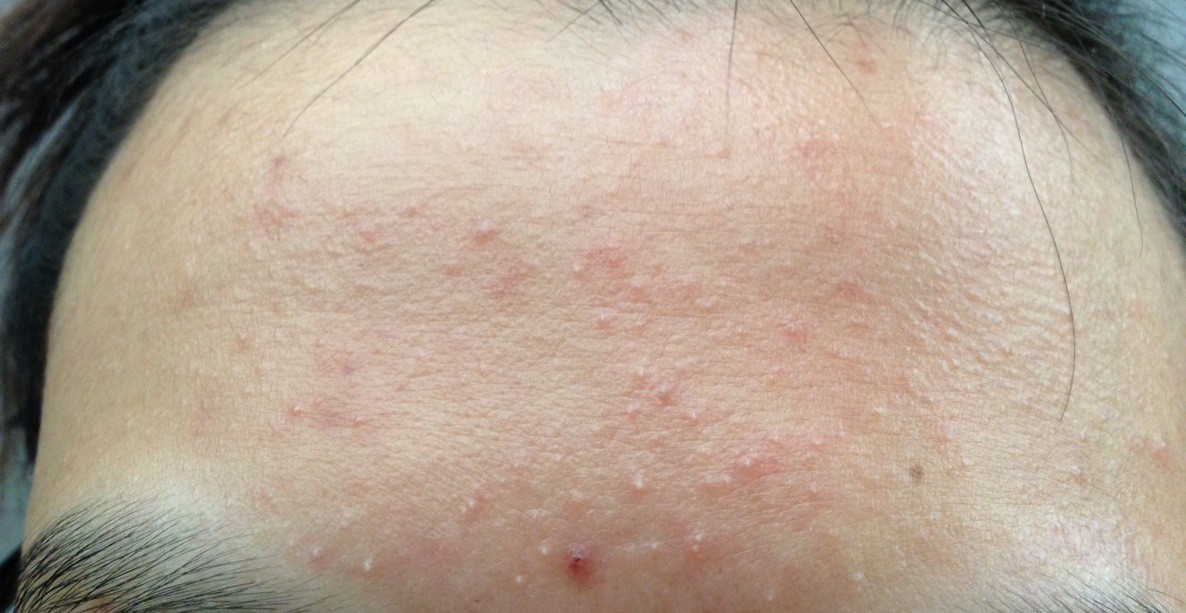 第一类:白头粉刺怎样判断脸上的痘痘属于哪一类型呢?