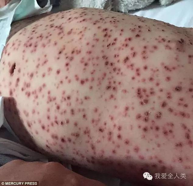 2岁孩子全身布满红色斑点系最严重水痘