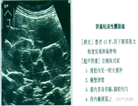 卵巢子宮內膜異位症(巧克力囊腫)臨床表現:痛經,性交痛,不孕聲像圖:大