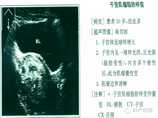 子宮腺肌症子宮腺肌症好發部位:後壁多見,其次為宮底部臨床表現:痛經