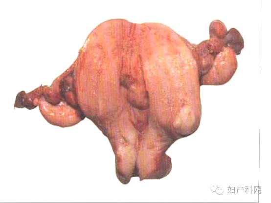 子宫内膜息肉子宫内膜息肉子宫内膜增生症子宫发育异常由于胚胎期苗勒