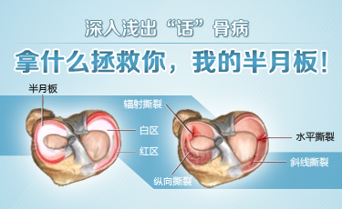 半月板损伤的原因图片