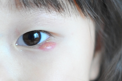 孩子眼睛上的肉疙瘩究竟是麦粒肿还是霰粒肿?