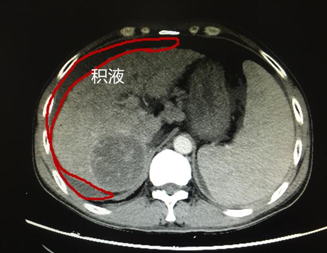 下面一张是该患者的腹部ct,注意红色圈中的颜色和其它肝脏组织明显