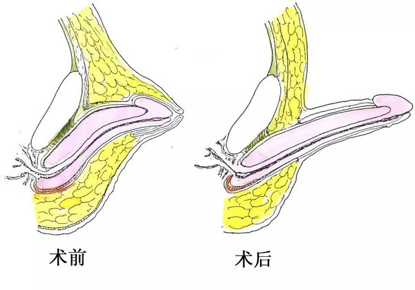 天哪丨7岁小男孩竟然到医院做鸡鸡延长手术!