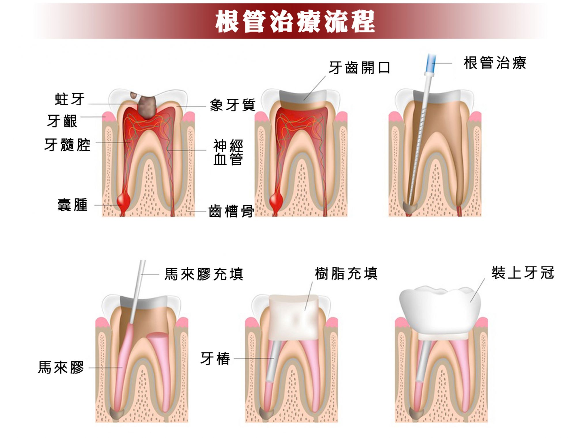 根管治疗要几次图片