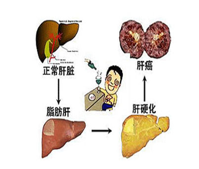 肝硬化病人口渴咋回事_肝硬化病人图片