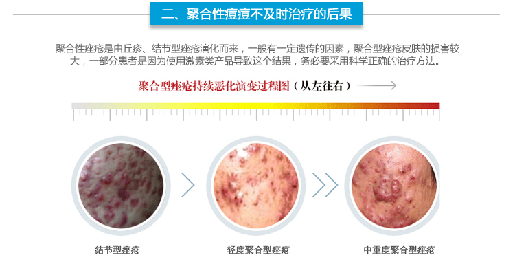 此外,尚有一種特殊類型的痤瘡,稱為聚合性痤瘡(acneconglobata),多