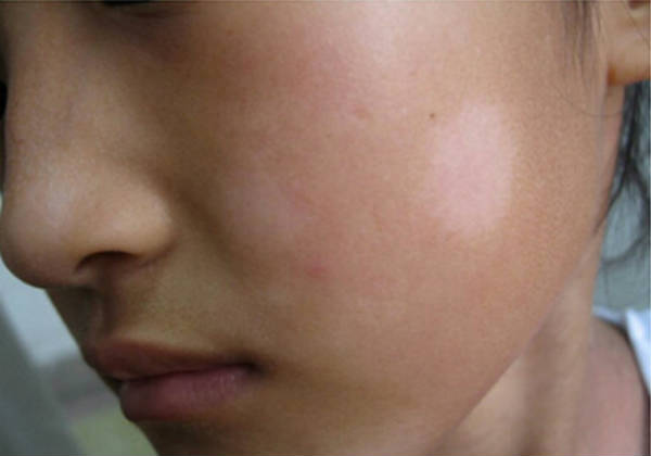 白糠疹,儿童脸上的圆形白斑逐步扩散