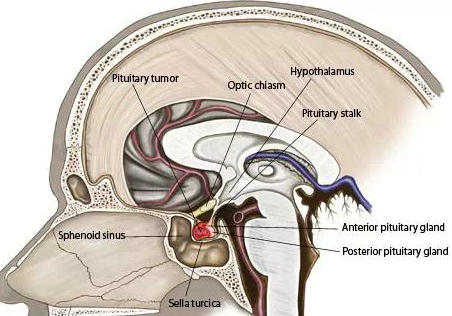 脑垂体瘤不容忽视的病变