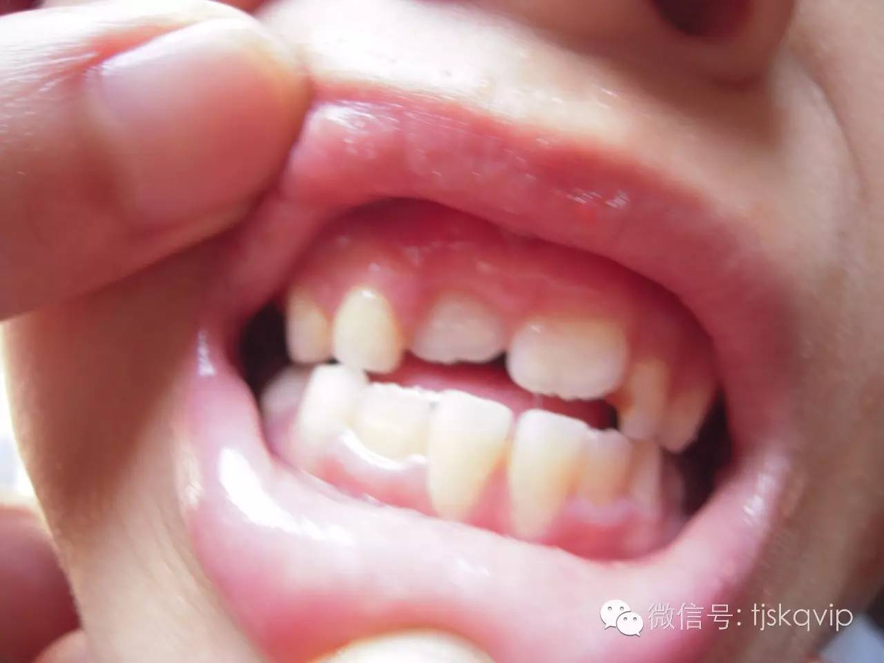 一些妈妈认为在换牙期给孩子吃软一点的食物,这样长出来的牙齿可以很