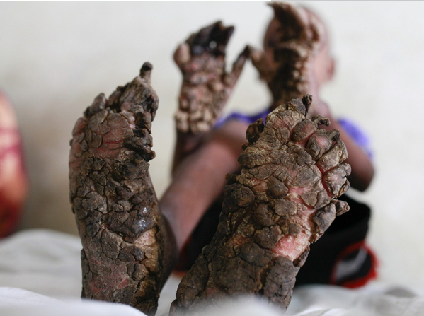 孟加拉国男童患树人病手脚生出树枝树根