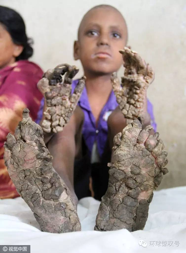 孟加拉国7岁男童患罕见树人病手脚生出树枝树根