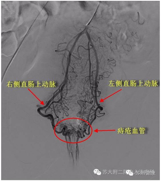 从右侧大腿根部穿刺一个1mm左右的针眼进入大腿根部的股动脉,沿着血管