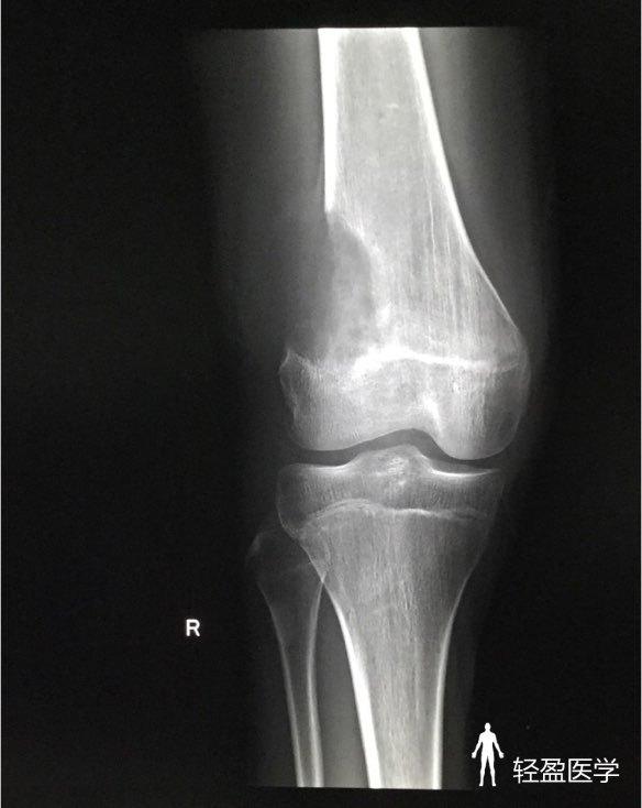 男,15岁下楼梯时扭伤右腿,诊断:骨肉瘤?