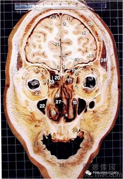 經典顱腦斷層解剖圖冠狀位