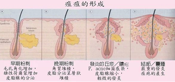 痘痘因人而异 找对属于自己的祛痘方法