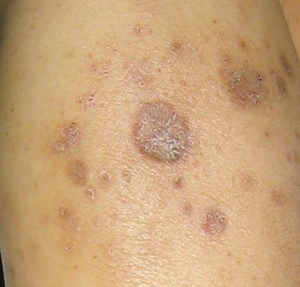 淋巴瘤长皮疹的图片图片