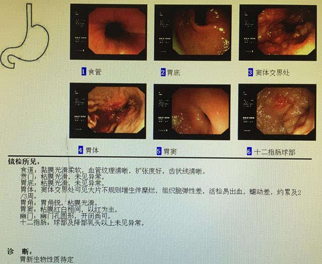 胃癌晚期胃镜图片图片