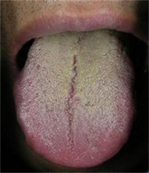 舌体胖大有齿痕黄腻是怎么回事该怎么办
