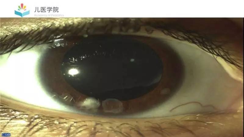 眼睛母细胞瘤晚期图片图片