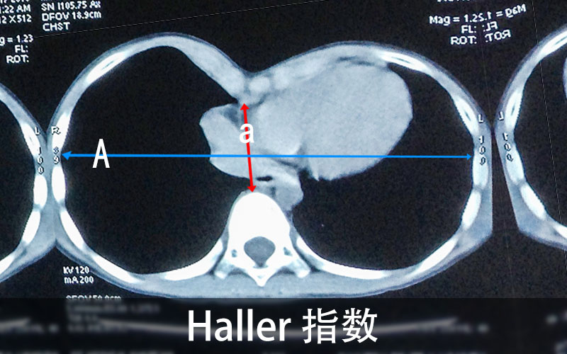 假性漏斗胸图片 正常图片